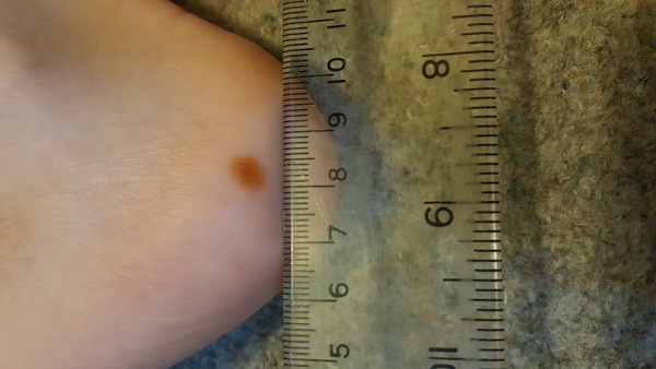 Sudden appearance of large mole on 6yo