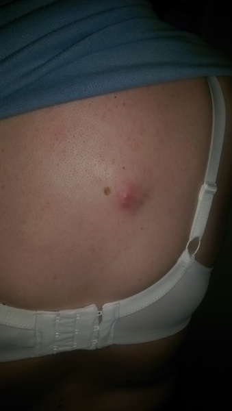 Come and look at this lump/spot/cyst and advise me please