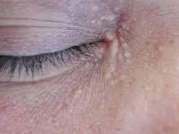 Xanthelasma  (cholesterol deposits around eyes)...
