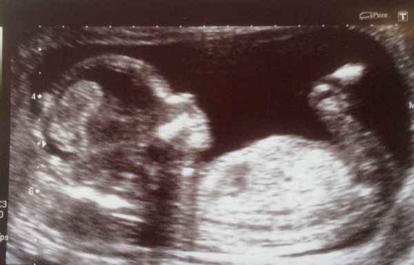 December 2016 babies... 2nd trimester in sight