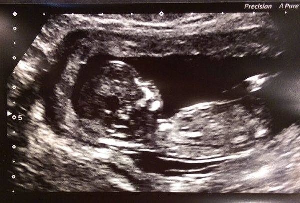 December 2016 babies... 2nd trimester in sight