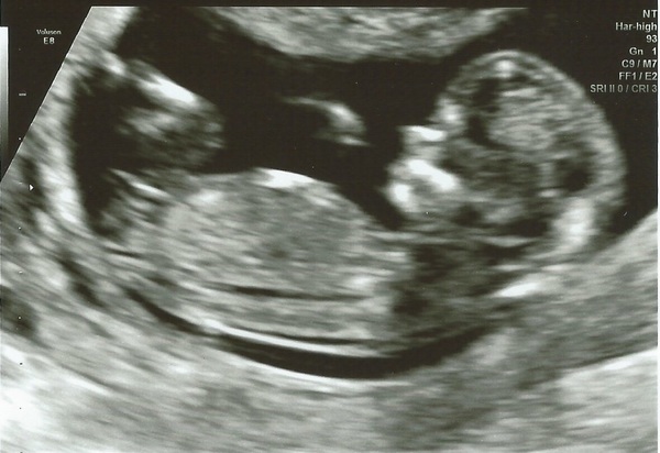 December 2016 babies... 2nd trimester in sight