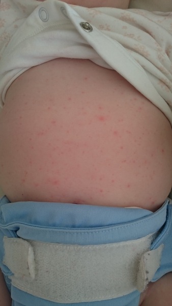 Does this look like prickly heat? (picture)
