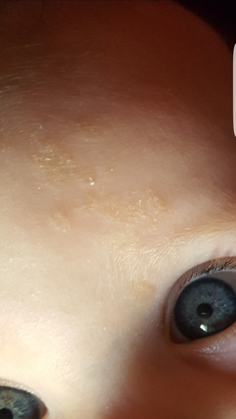 6mth old has a discoloured dry patch on forehead (picture)