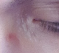 Xanthelasma  (cholesterol deposits around eyes)...