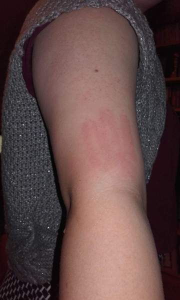14 month old with hives from being touched.