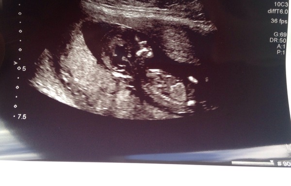 Late December - Early January '17 Babies