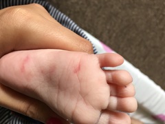 Mark/bruise on 3month old foot