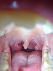 Do I have throat cancer..