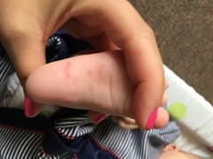 Mark/bruise on 3month old foot
