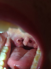 Throat cancer .? Tonsillitis HELP