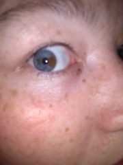 Can chicken pox appear on the actual eyeball?