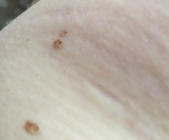What are these marks on my breasts?