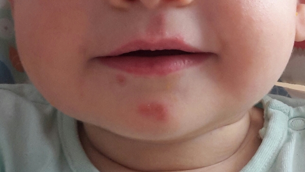 Sore patches on face - picture
