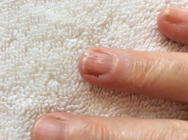 Any nail experts able to advise?