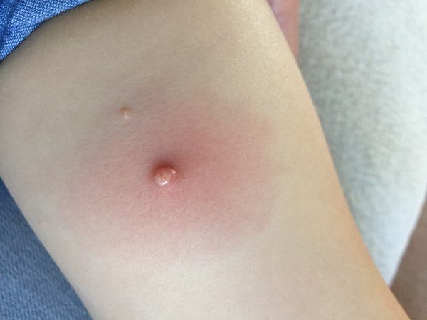 Molluscum question! Please!