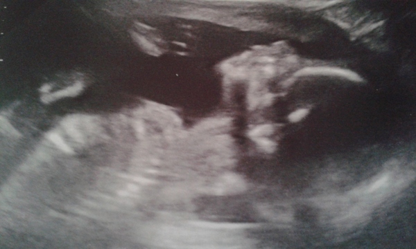 is this a potty shot? scan pic 20plus3, boy or girl?
