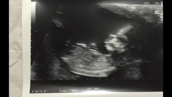 Boy or Girl???