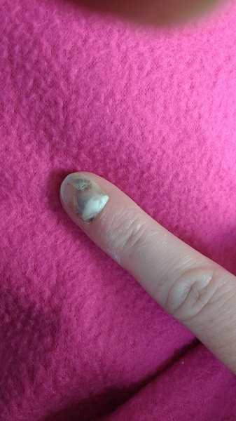 Nail half off