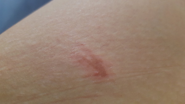 Strange patch of skin