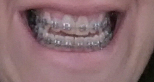Adult braces anyone?