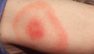 Lyme Disease?