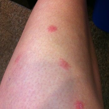 Help,  are these bedbug bites?