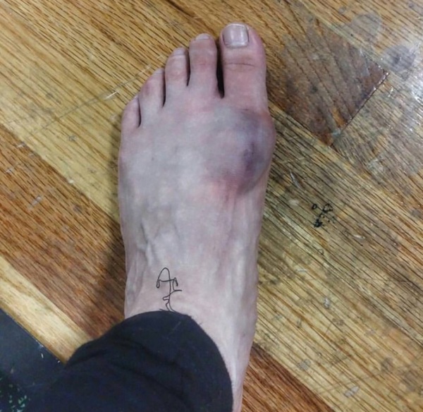 What the hell is wrong with DH's foot? It doesn't hurt, but is it an A&E thing?