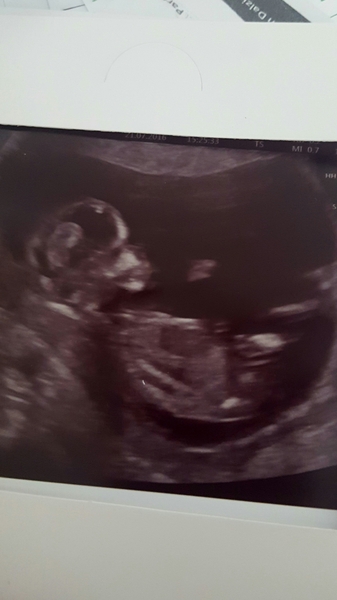 Pregnancy after infertility II