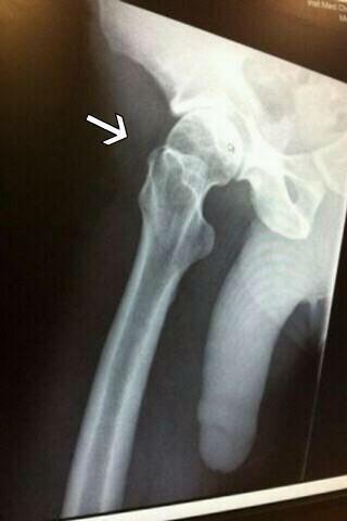 To think this is an obvious fracture? Pic