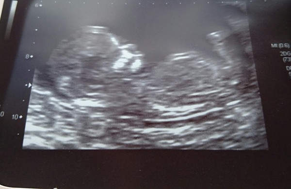 Boy or Girl???