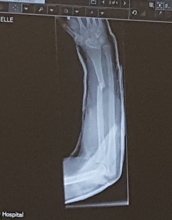 To get a 2nd opinion on DD's broken arm?
