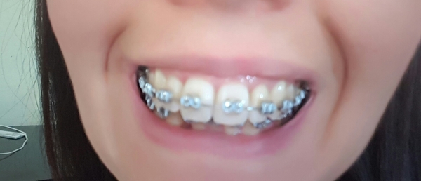 Adult braces anyone?