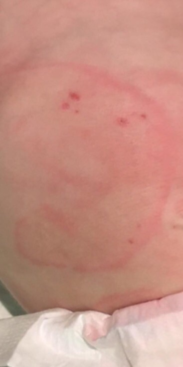 daughter has a leg rash. any ideas?
