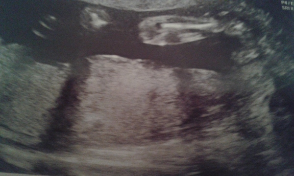 is this a potty shot? scan pic 20plus3, boy or girl?