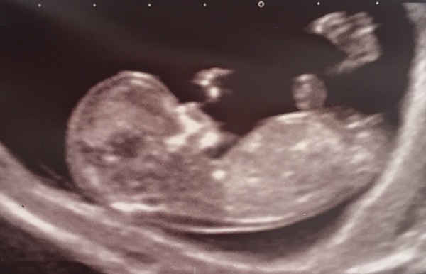 Boy or girl?! Scan pics xxx