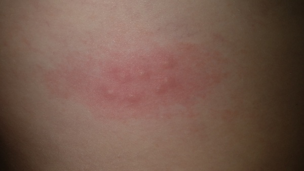 Help,  are these bedbug bites?