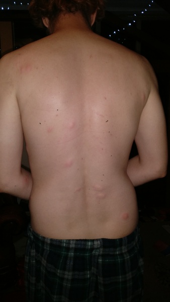 Help,  are these bedbug bites?