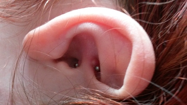 Anyone want to pierce and squeeze the cartilage bump on my daith piercing?
