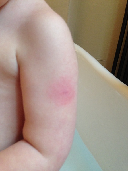 Poorly 2.5 yr old, BCG site inflamed (picture inc)