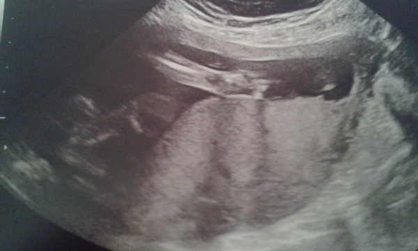is this a potty shot? scan pic 20plus3, boy or girl?