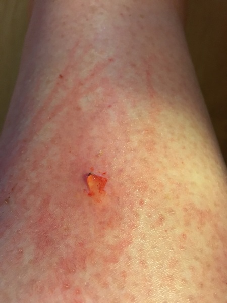 Warning- picture. What has bitten me?