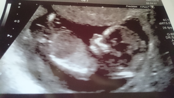 TTC through Donor IUI or Donor IVF or just undecided - all welcome! #makeithappen