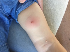 Molluscum question! Please!