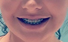 Adult braces anyone?