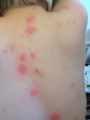 Does anyone recognise these bites?