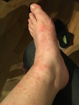 Heat rash, bites or something else?