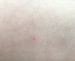 Does this look like chicken pox? (Photos included)