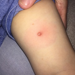 Molluscum question! Please!
