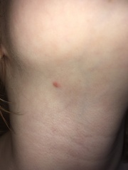 Does this look like chicken pox? (Photos included)